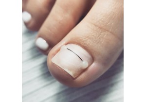 Лечение вросшего ногтя (установка титановой нити)