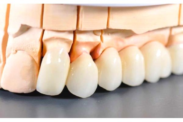 Коронки из циркония в стоматологии