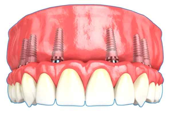 Несъемное протезирование зубов на имплантах