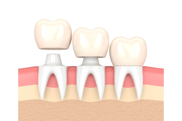Коронки на нижние зубы