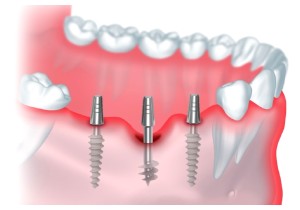 Базальная имплантация зубов  