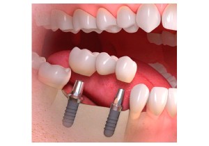 Имплантация задних зубов
