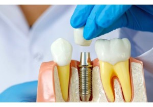 Полная имплантация зубов