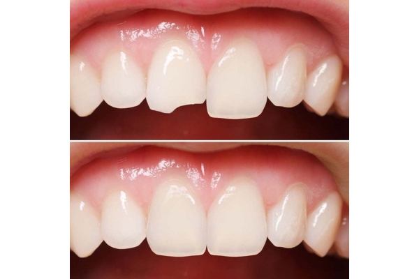 Восстановление формы зуба 