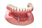 Коронка на имплант переднего зуба