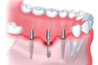 Базальная имплантация зубов  