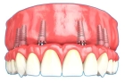 Несъемное протезирование зубов на имплантах
