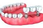 Зубные протезы на 4 имплантах