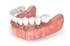 Зубные протезы на 6 имплантах