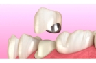 Коронки на жевательный зуб