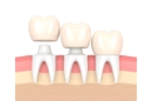Коронки на нижние зубы