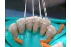 Шинирование зубов при переломе