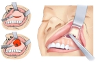Резекция корня зуба