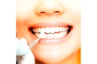 Эстетическая реставрация зуба