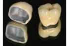 Недорогие коронки металлокерамика на зубы